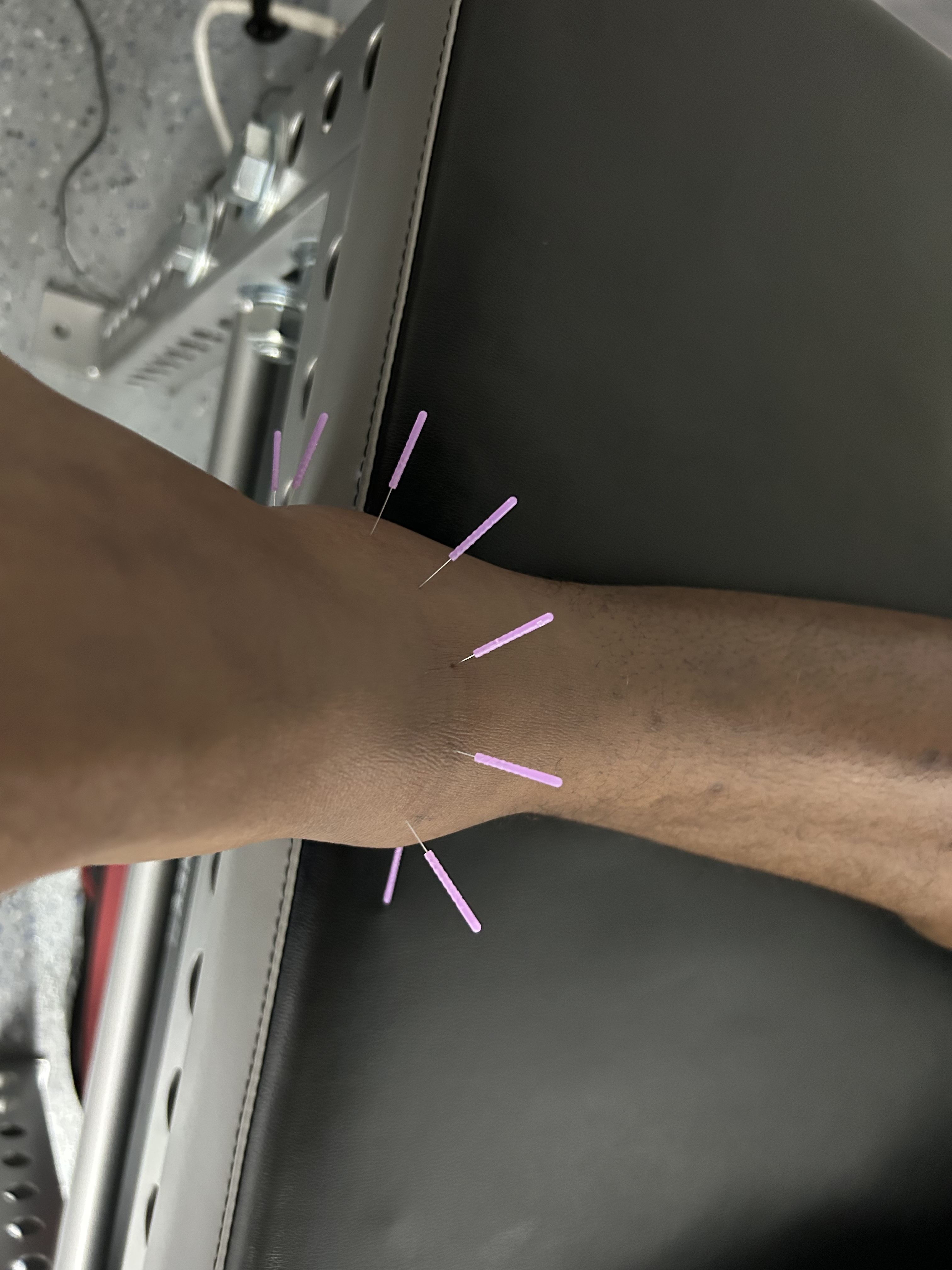 dry-needling