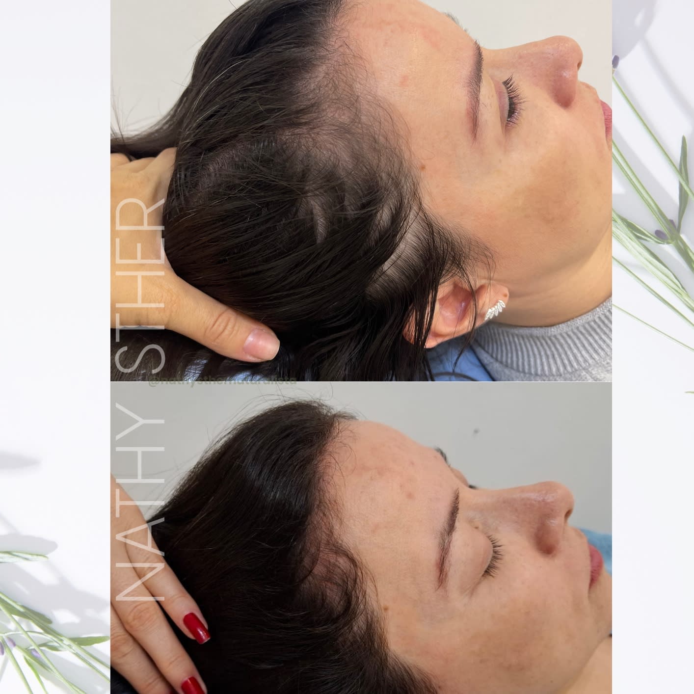 ANÁLISE GRATUITA PRA VOCÊ QUE NOS CONHECEU POR ESSE POST ✨

USOU MONJARO E PERDEU CABELO? 🚨

Você conquistou o emagrecimento que desejava, mas começou a perceber o cabelo caindo, o volume diminuindo e o couro cabeludo ficando cada vez mais aparente?

⚠️ A perda de peso rápida pode estar associada ao aumento da queda capilar. Mudanças na ingestão de proteínas, deficiências nutricionais e o próprio estresse metabólico do emagrecimento podem contribuir para esse quadro.

Mas atenção: queda capilar não deve ser tratada apenas com vitaminas ou produtos que prometem crescimento!

🌿 No Centro de Terapia Capilar RENOVO, avaliamos o couro cabeludo e os fios para identificar as alterações presentes e direcionar um tratamento individualizado.

✨ Nosso objetivo é cuidar da saúde do couro cabeludo, preservar a qualidade dos fios e favorecer a recuperação capilar, respeitando as necessidades de cada pessoa.

Seu cabelo também merece atenção nessa fase!

📲 Agende sua avaliação capilar.

📍 Centro de Terapia Capilar RENOVO
Alphaville Lagoa dos Ingleses — Nova Lima/MG

Não espere o volume diminuir ainda mais para investigar a causa da queda.

RENOVO ✨ saúde capilar começa com uma avaliação individualizada.

NOS CONHECEU POR AQUI ? 
Sua análise é gratuita 🌸✨ 1