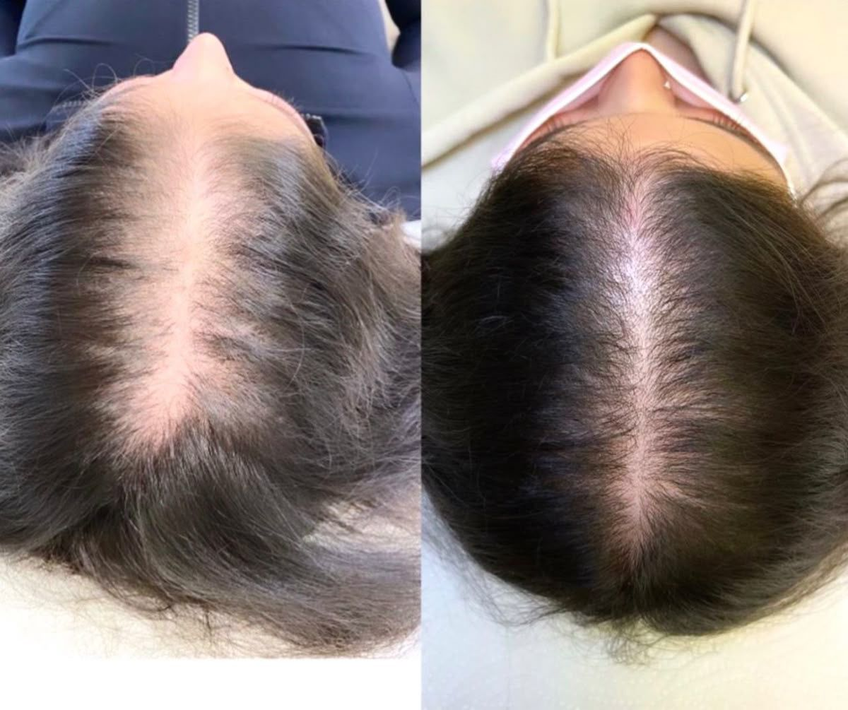 Hair Treatment 1