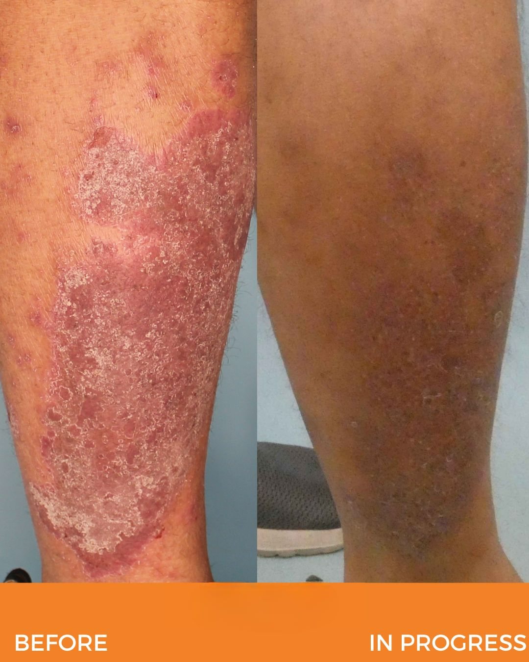 Psoriasis Treatment