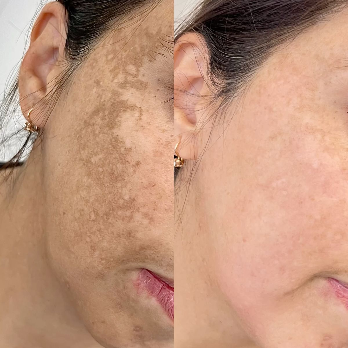 Skin Treatment 1