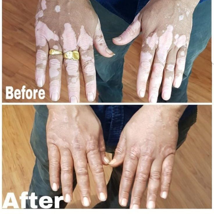 Vitiligo Restoration