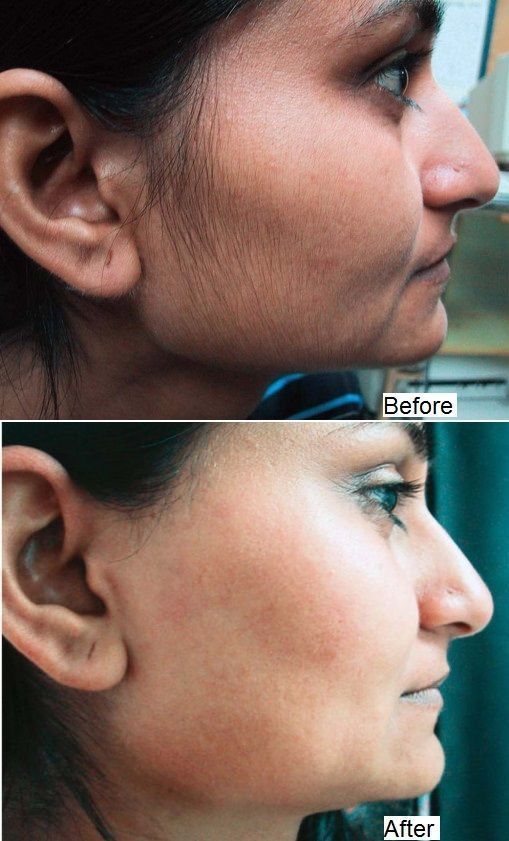 Facial Hair Removal & Skin Clarity