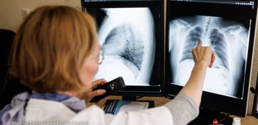 Opinion: TB is back as top infectious killer. AI can change that