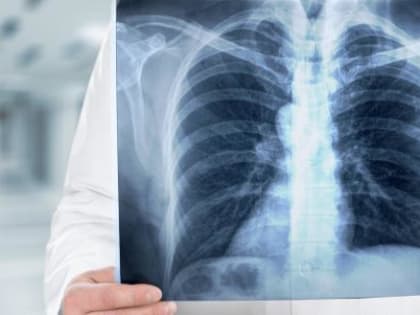 Искусственный интеллект поможет вологодским врачам выявлять патологии в легких на ранних стадиях