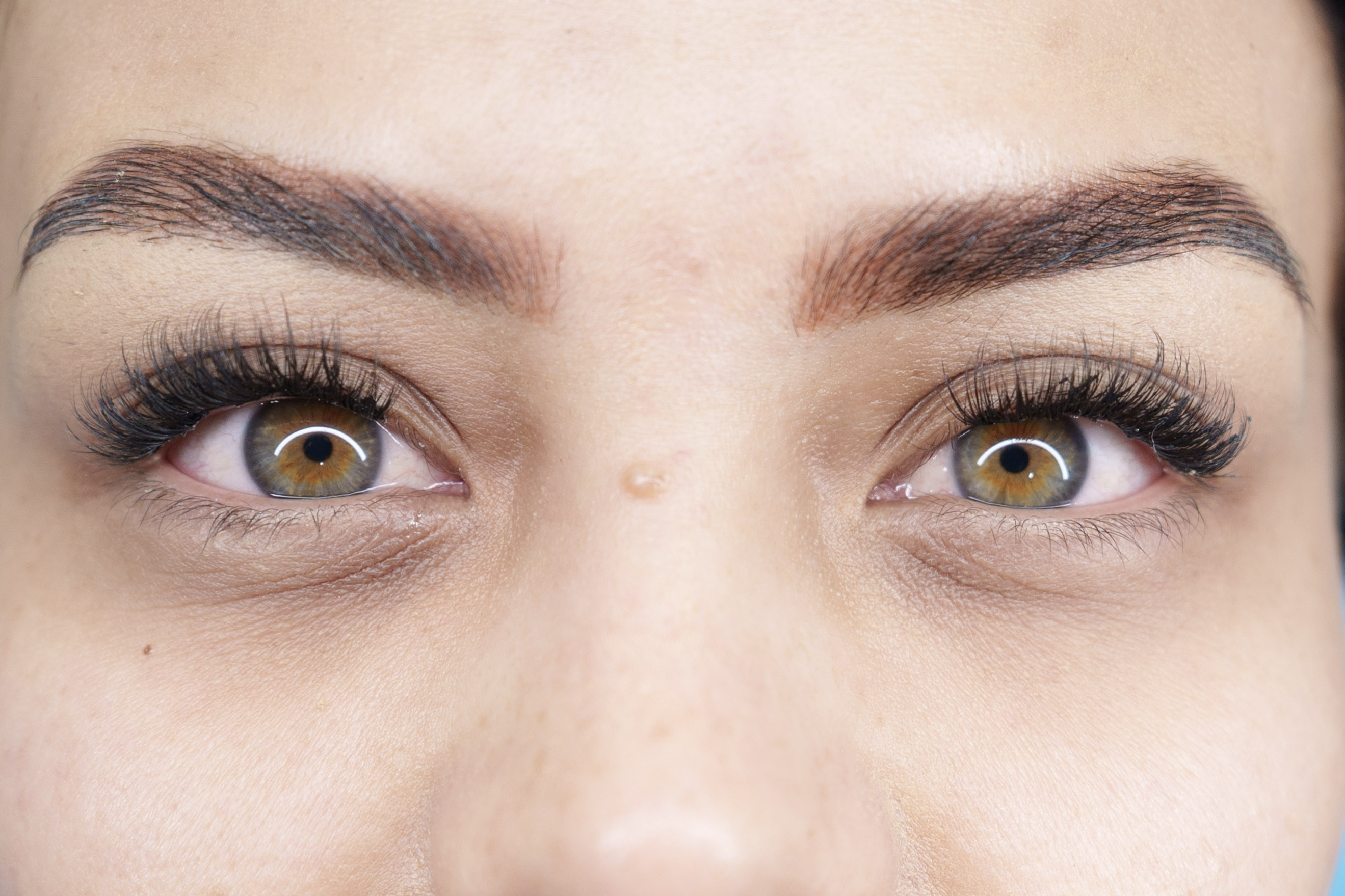 Después de tratamiento de ojeras en Colombia - Resultados reales