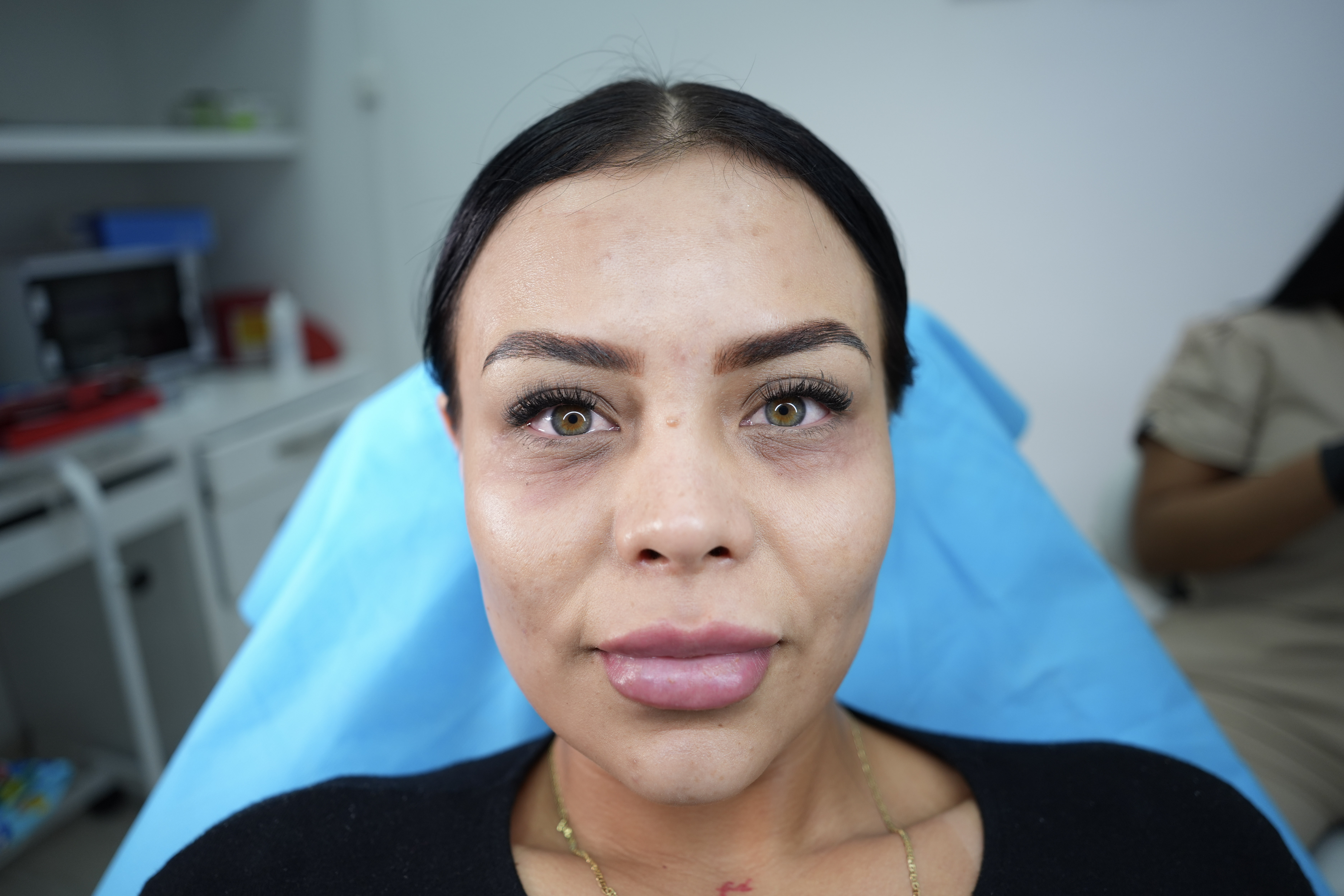 Antes de tratamiento de ojeras en Cali - Beauty Mansion