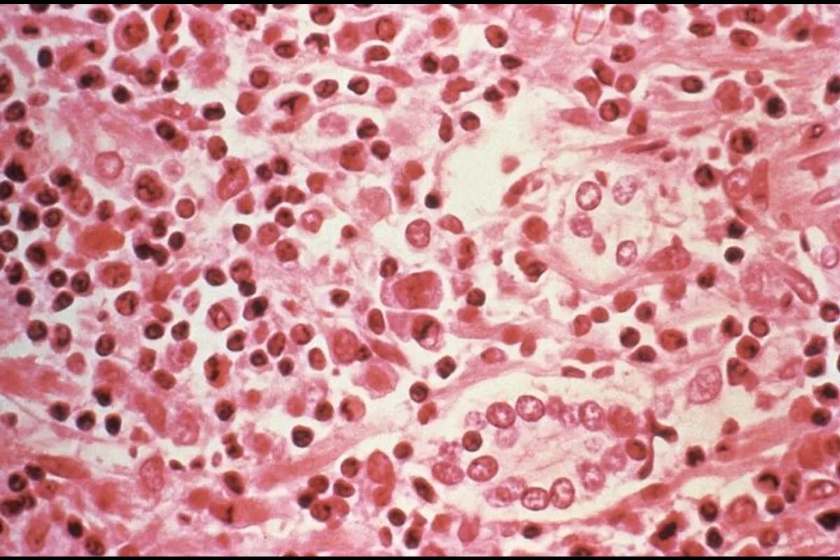 Hantavirus outbreak claims three lives in Venezuela