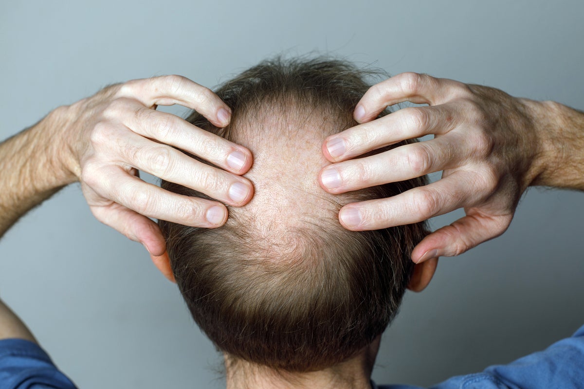 Study links weight loss medications to increased risk of hair loss
