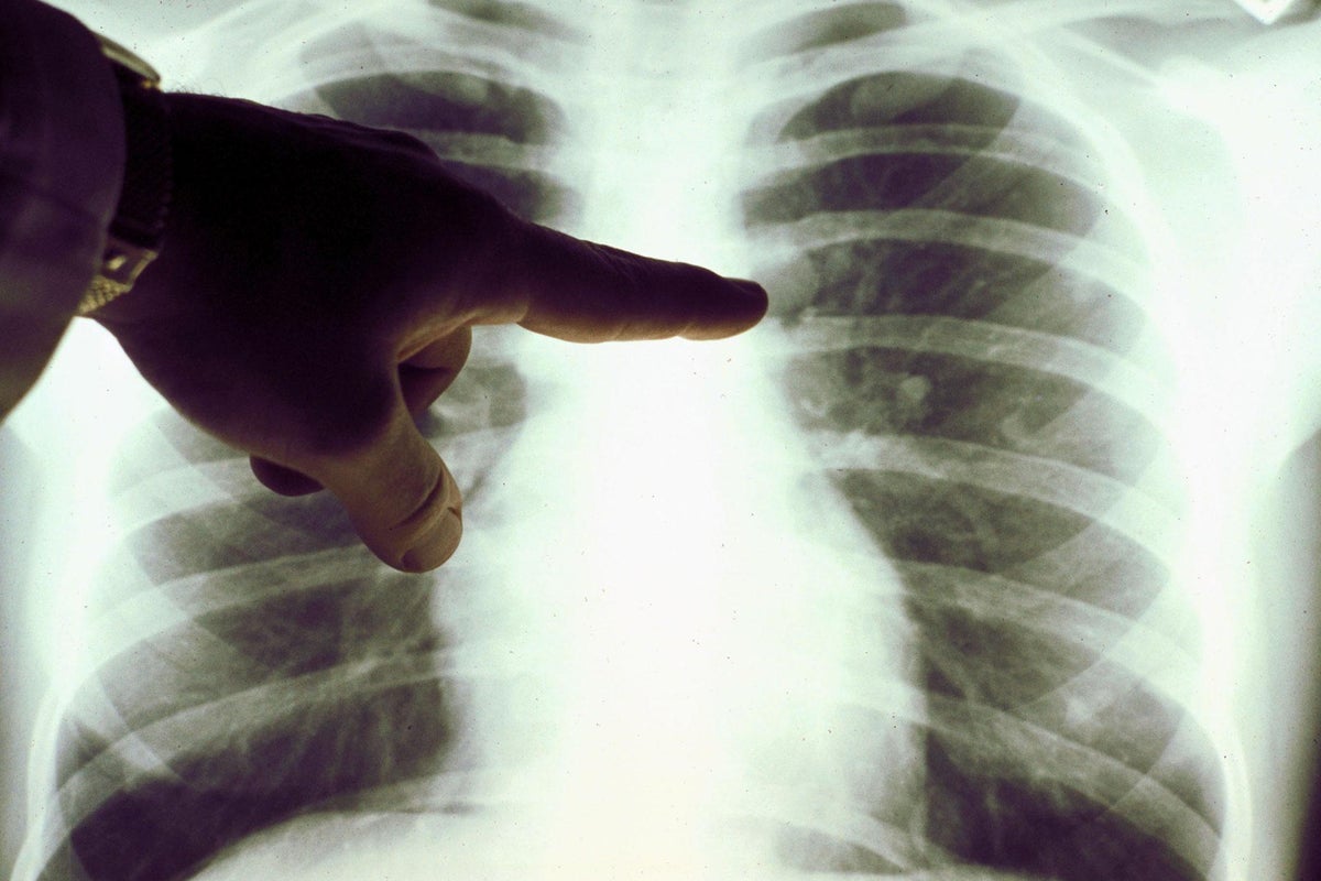 NHS to use lung preservation machine to help more transplant patients