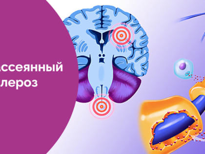 Общероссийский день рассеянного склероза
