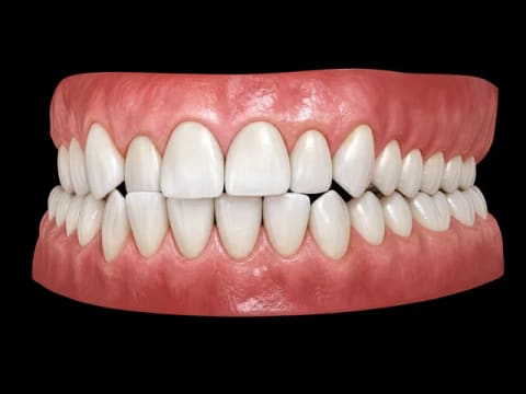 Cross Bite — 3D dental model