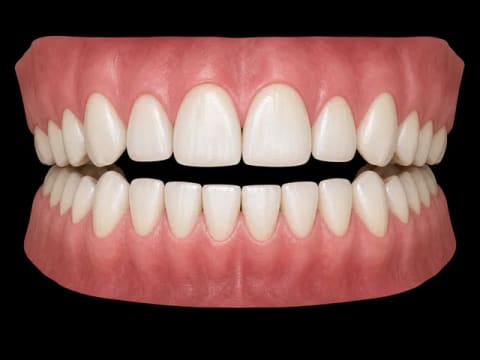 Open Bite — 3D dental model