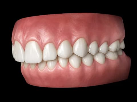 Over Bite — 3D dental model