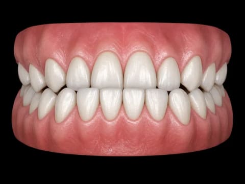 Under Bite — 3D dental model
