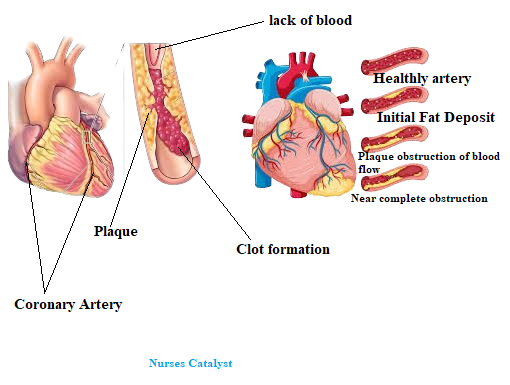 Coronary artery disease and what is management of coronory atery disease
