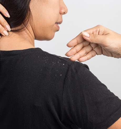 Dandruff Control in Hyderabad, Dandruff Control in Chennai, Dandruff Control in Bangalore