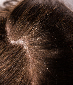 Dandruff Control in Vizag, Dandruff Control in Tiruapthi, Dandruff Control in Nellore