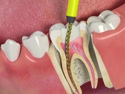 Trajtimet Endodontike