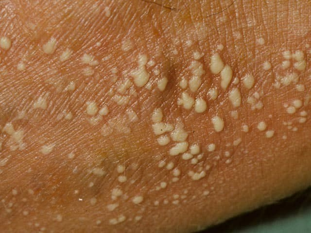 Generalized Pustular Psoriasis