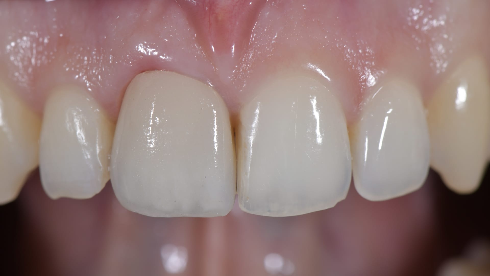 Faccette in ceramica prima e dopo - Estetica dentale Torino