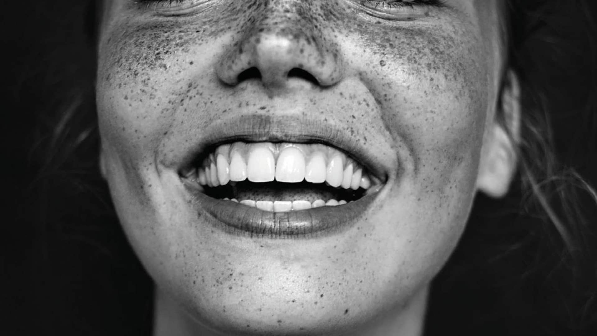 Ortodonzia invisibile con allineatori trasparenti Torino