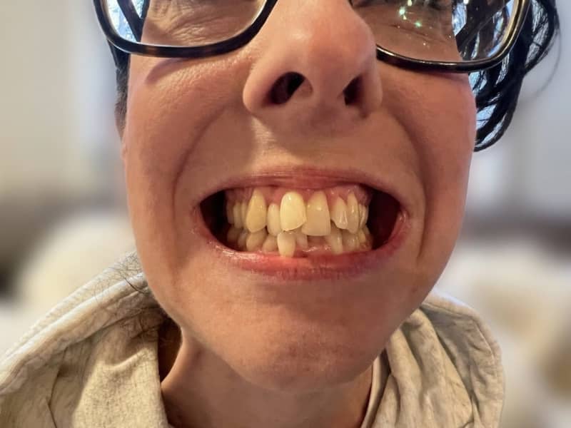 Affollamento dentale prima del trattamento di ortodonzia invisibile