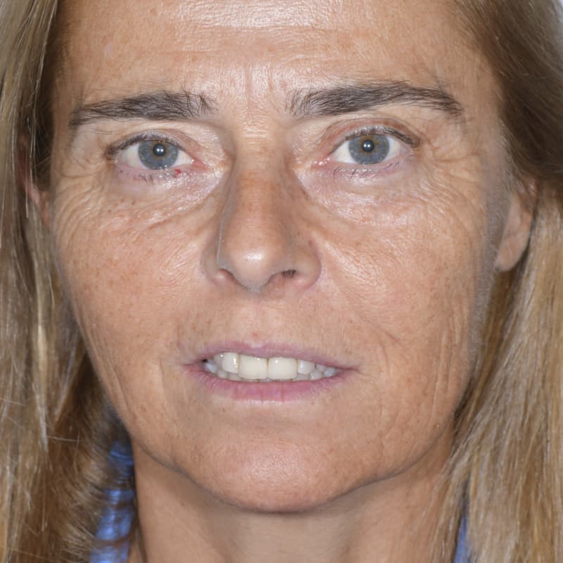 Situazione di edentulia totale prima della riabilitazione Full Arch