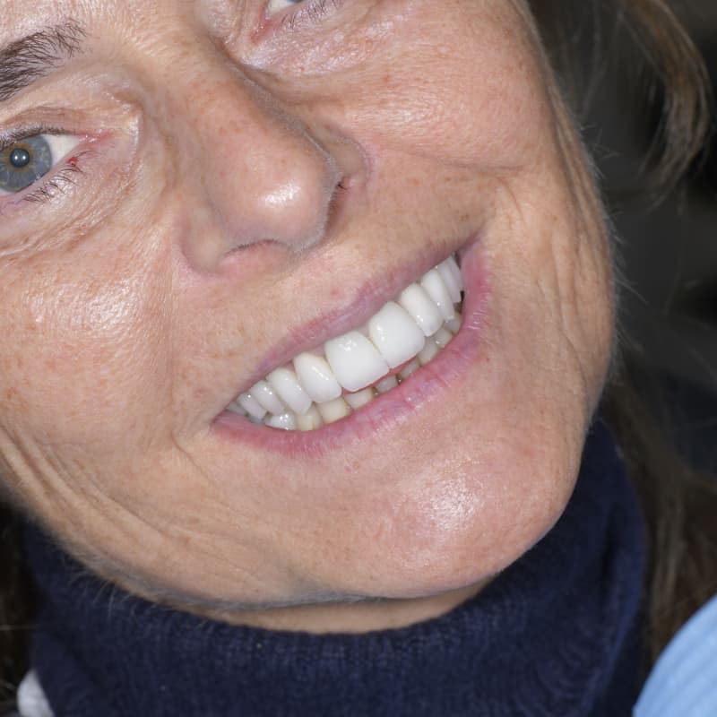 Trasformazione completa del sorriso tramite riabilitazione complessa Full Arch
