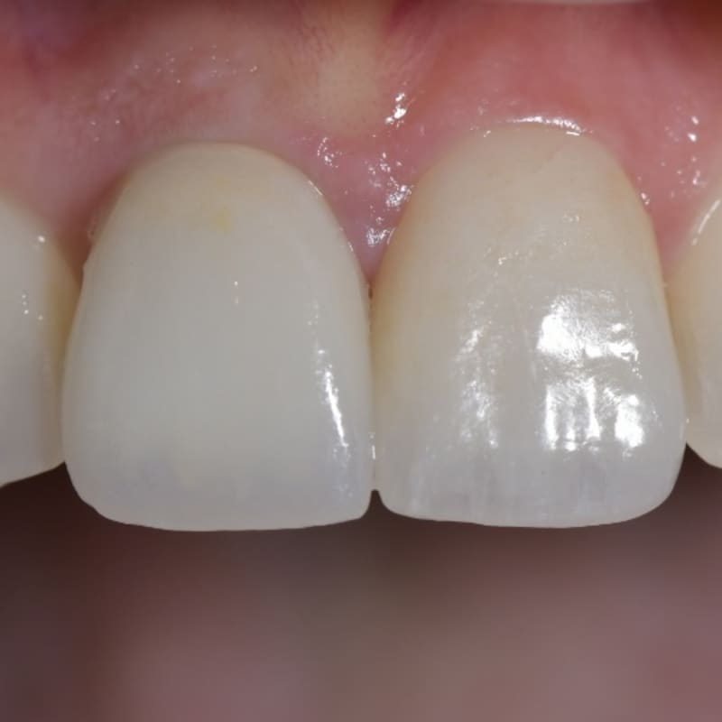 Dopo l'applicazione di faccette complete artigianali a Torino