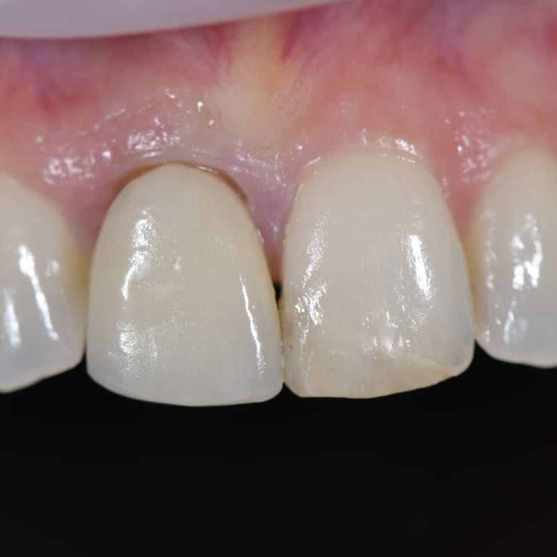 Prima dell'applicazione di faccette complete artigianali