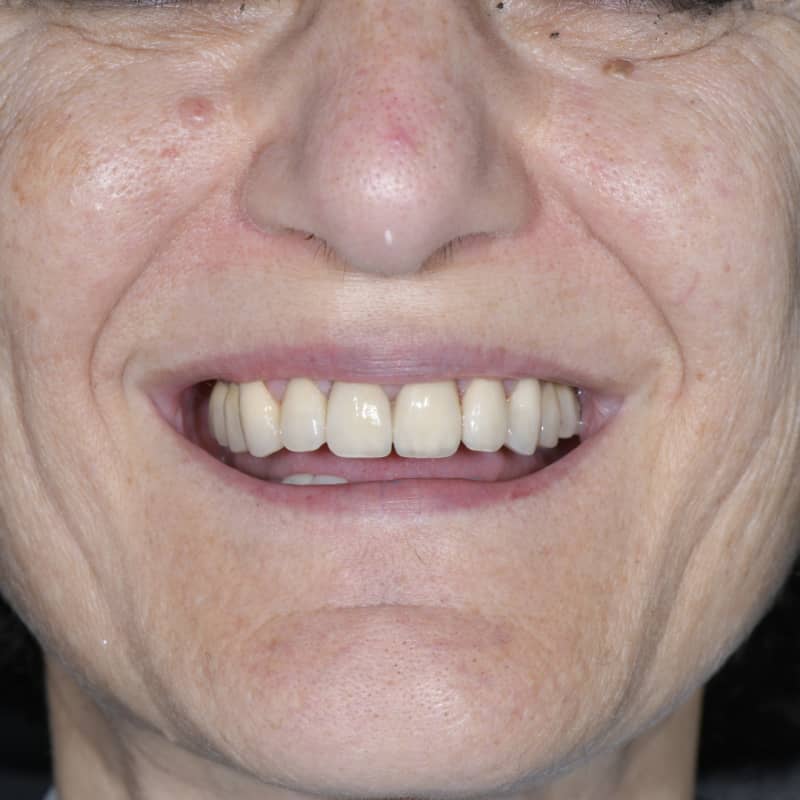 Risultato finale di una riabilitazione protesica avanzata su impianti