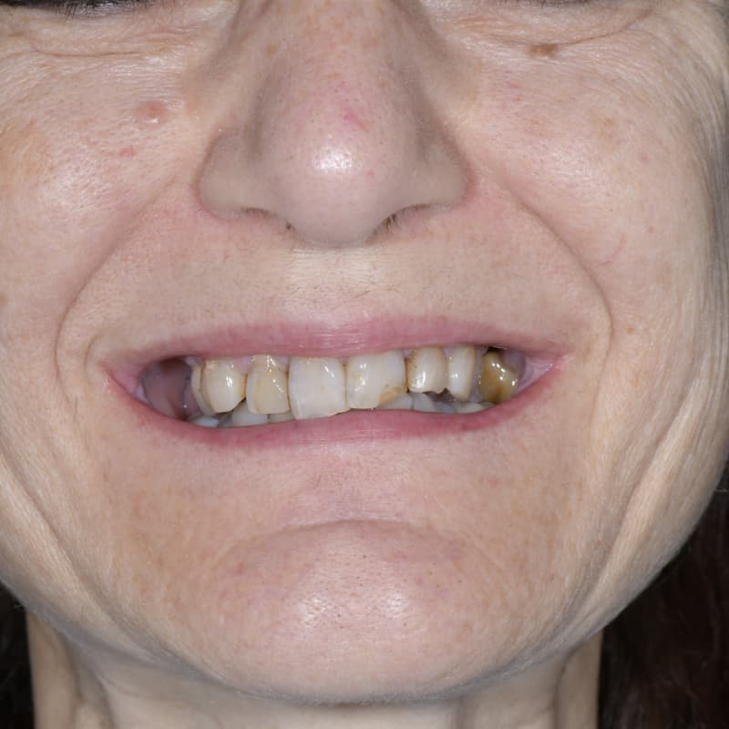 Situazione prima della riabilitazione protesica su impianti