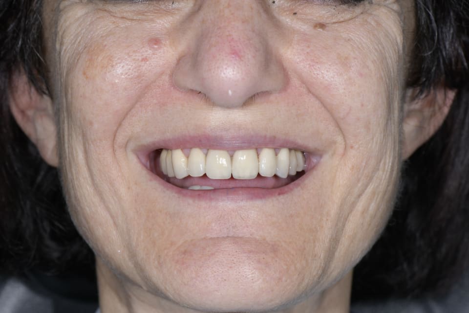 Dopo la riabilitazione su impianti e denti naturali