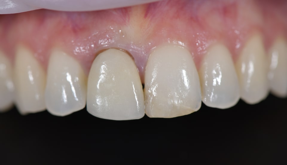 Prima dei restauri in ceramica feldspatica