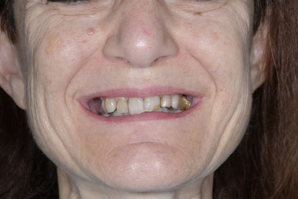 Prima della riabilitazione su impianti e denti naturali