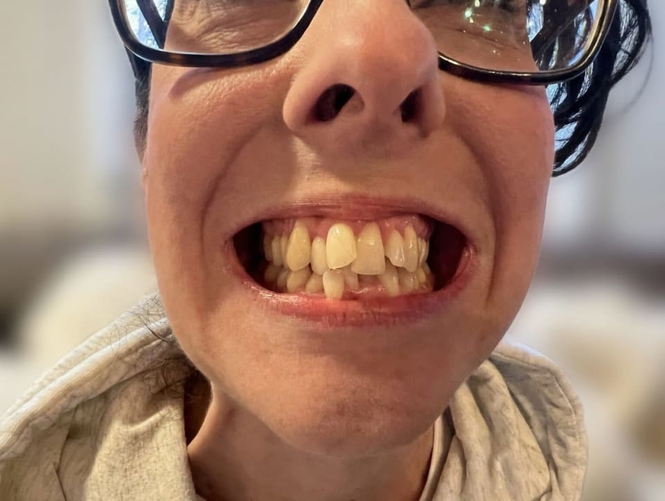 Affollamento dentale prima degli allineatori trasparenti