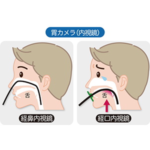 胃 部 内 視 鏡 検査 内視鏡検査 内視鏡検査q A オリンパス おなかの健康ドットコム Amp Petmd Com