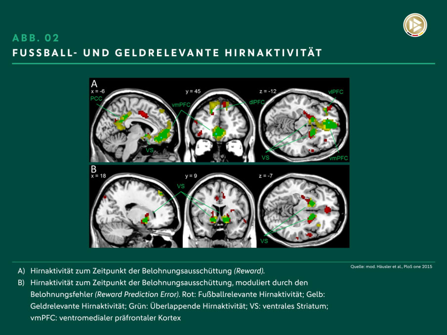 Abbildung 02: Fußball- und geldrelevante Hirnaktivität Es werden Aufnahmen eines menschlichen Gehirns gezeigt und die entsprechenden Hirnareale bzw. die Hirnaktivität bei Belohnungsausschüttung.