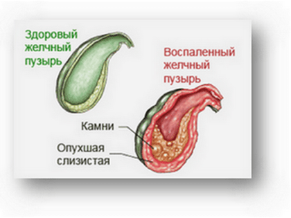 Профилактика желчнокаменной болезни