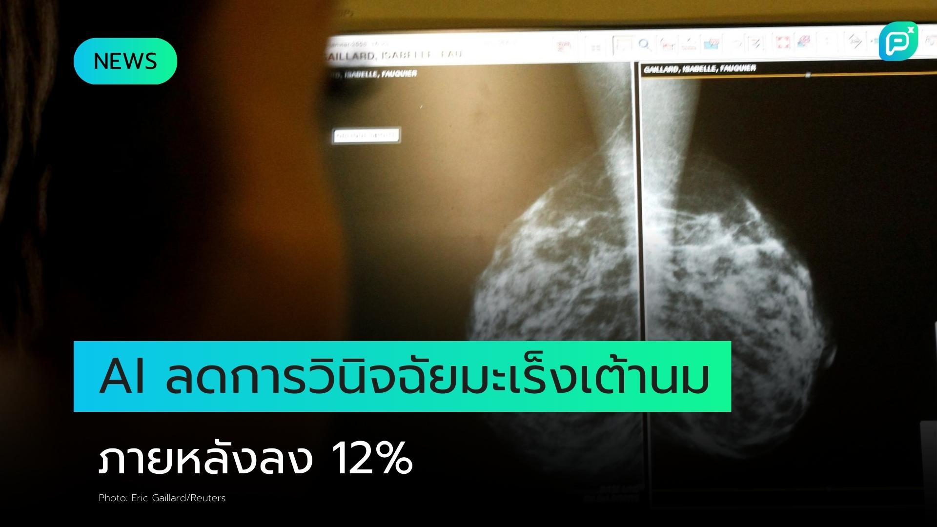 AI ช่วยลดอัตราการวินิจฉัยมะเร็งเต้านมภายหลังลง 12% ตามผลการศึกษาใหม่