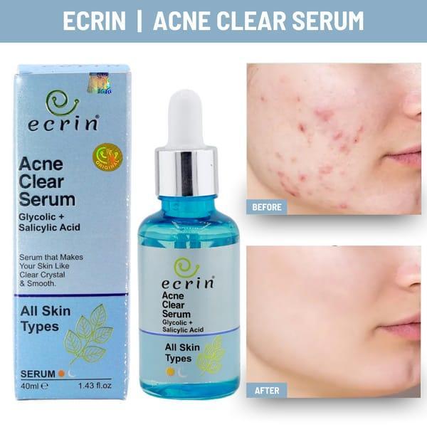 Acne Clear Salicylic Acid Serum – 40ml | Anti-Acne, Dark Spot & Skin Repair Solution