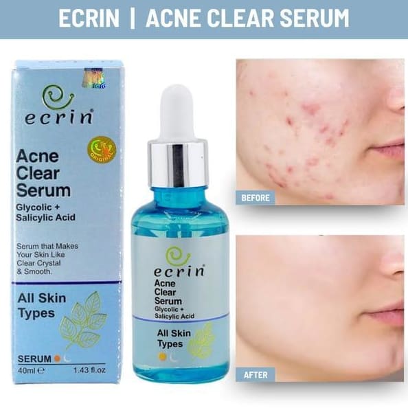 Acne Clear Salicylic Acid Serum – 40ml | Anti-Acne, Dark Spot & Skin Repair Solution