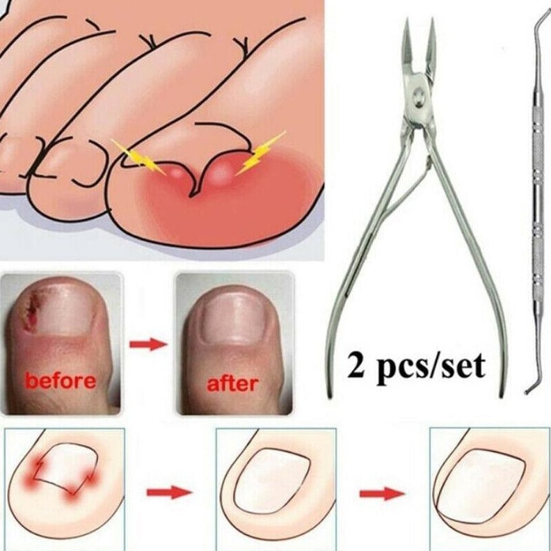 Premium Toe Nail Fixer Set Pakistan | Stainless Steel Ingrown Toenail & Dead Skin Remover