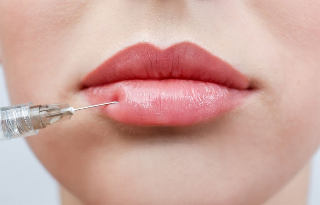 lip filling