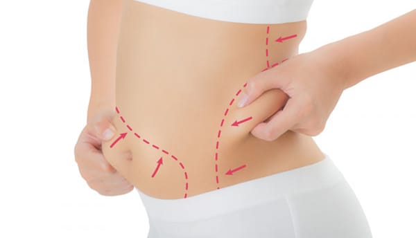 liposuction in Delhi