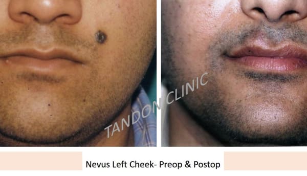 mole removal in Punjabi Bagh