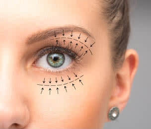 blepharoplasty in Delhi