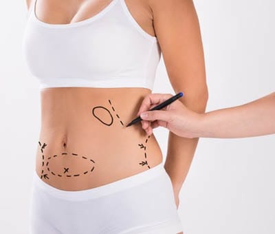 liposuction in Rohini