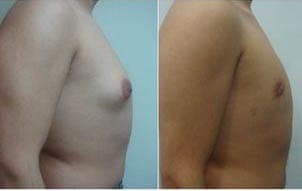 gynecomastia surgery in Delhi
